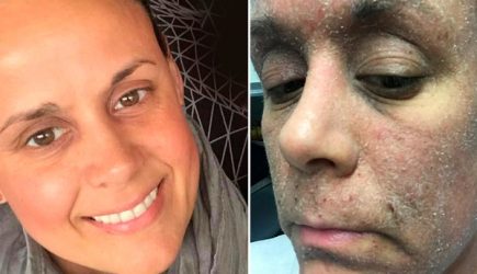 Женщина &laquo;превратилась в зомби&raquo; из-за крема для кожи