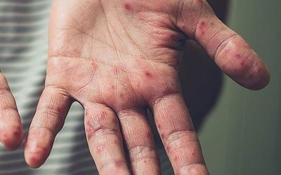 Опасную инфекцию завезли в РФ из Турции: врачи бьют тревогу