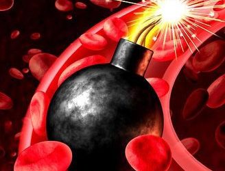 Холестериновые бомбы: продукты приводящие к закупорке сосудов