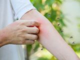 Как снять зуд после укуса насекомых: назван проверенный способ