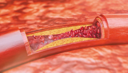 Первый признак накопления холестерина видно при ходьбе