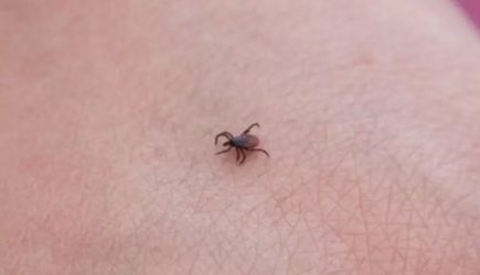 Что делать, если голова клеща оторвалась и осталась в теле: обязательно удалять или выйдет сама