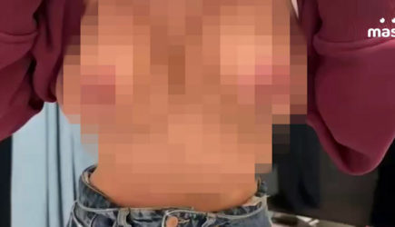 Женщине, потратившей 1,5 млн на пластику, изуродовали грудь в клинике