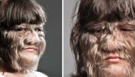 Как изменилась «самая волосатая девочка в мире»: сейчас ей 25 лет, и она выглядит совершенно иначе